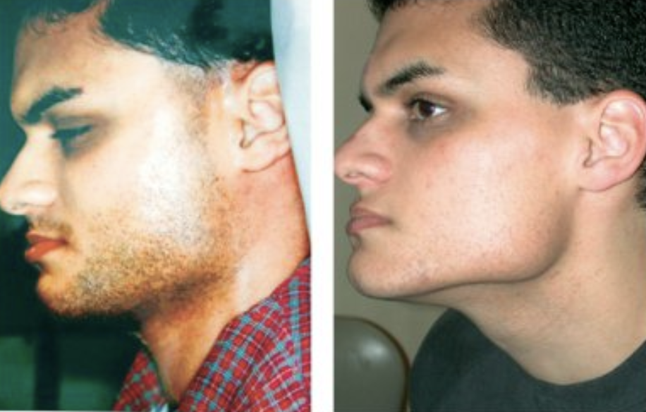 laser hair removal beard before and after